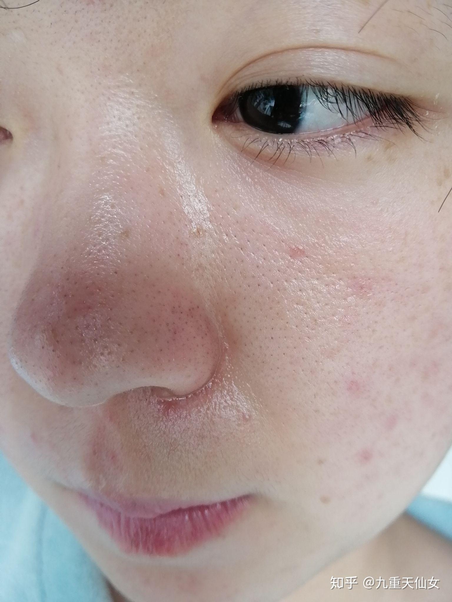 毛孔大皮肤暗黄出油用什么护肤品好