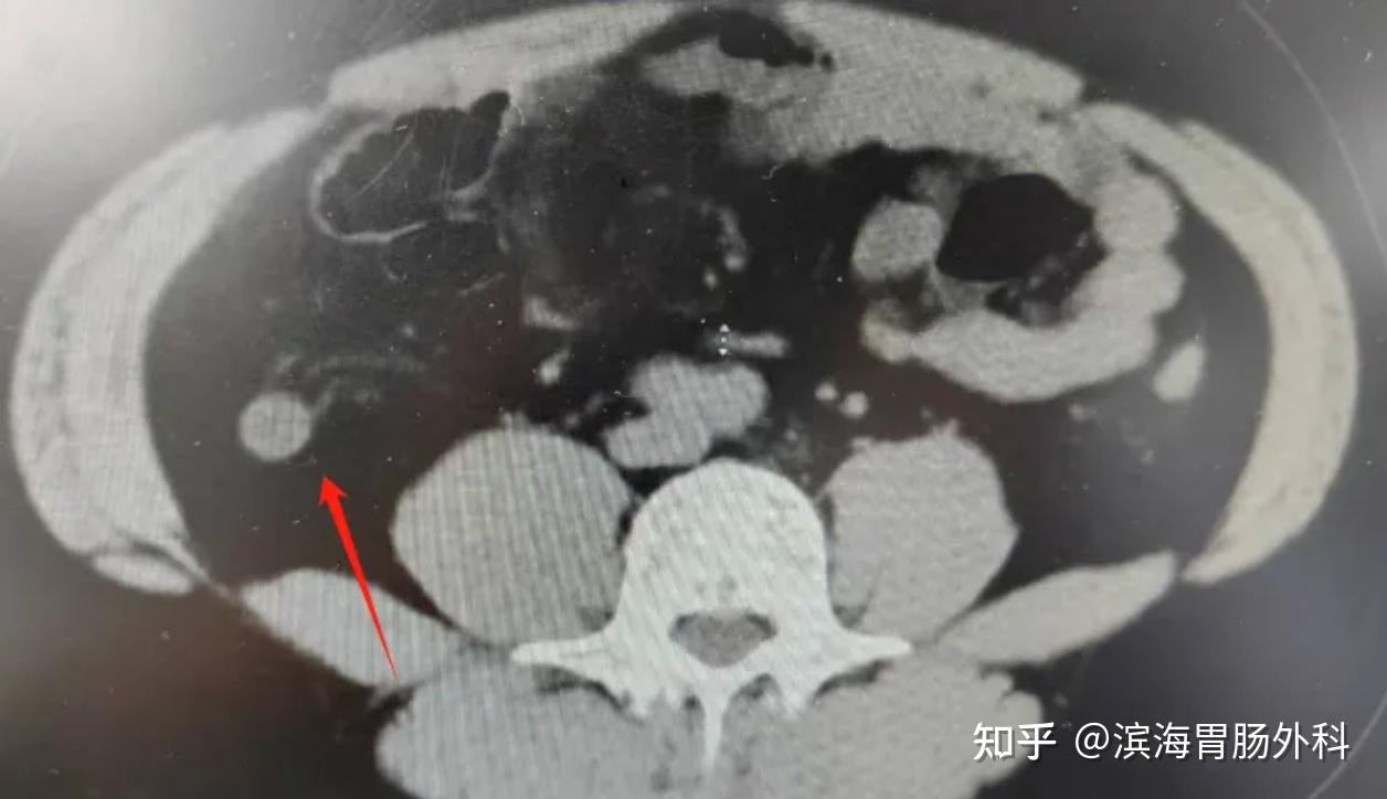 阑尾炎的非手术治疗以及腹膜后阑尾炎 - 知乎