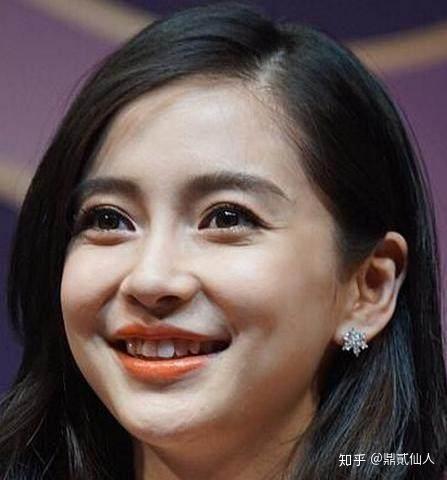 笑肌断层怎样导致的或者怎样改善