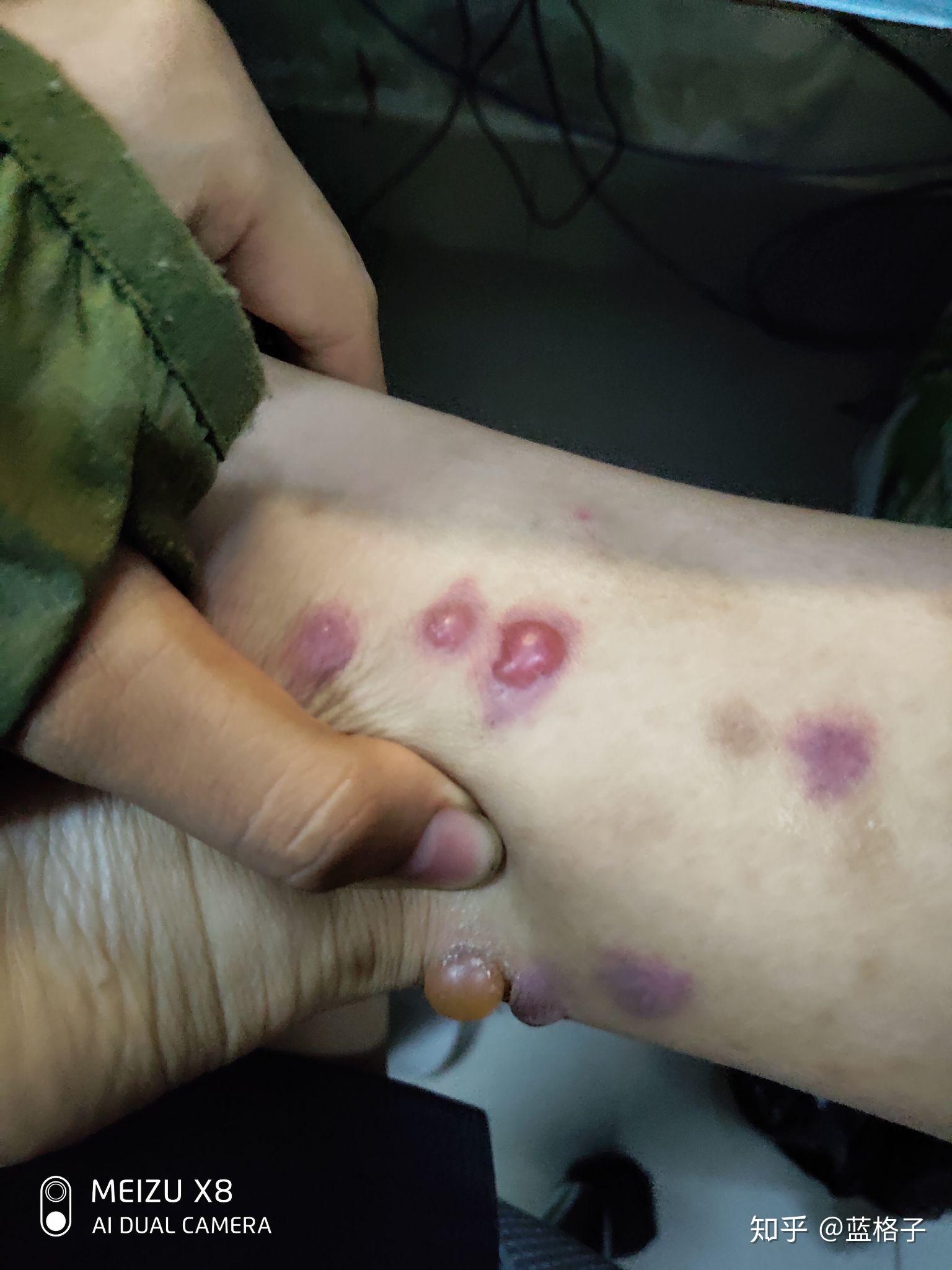 请问这到底是什么丘疹性荨麻疹