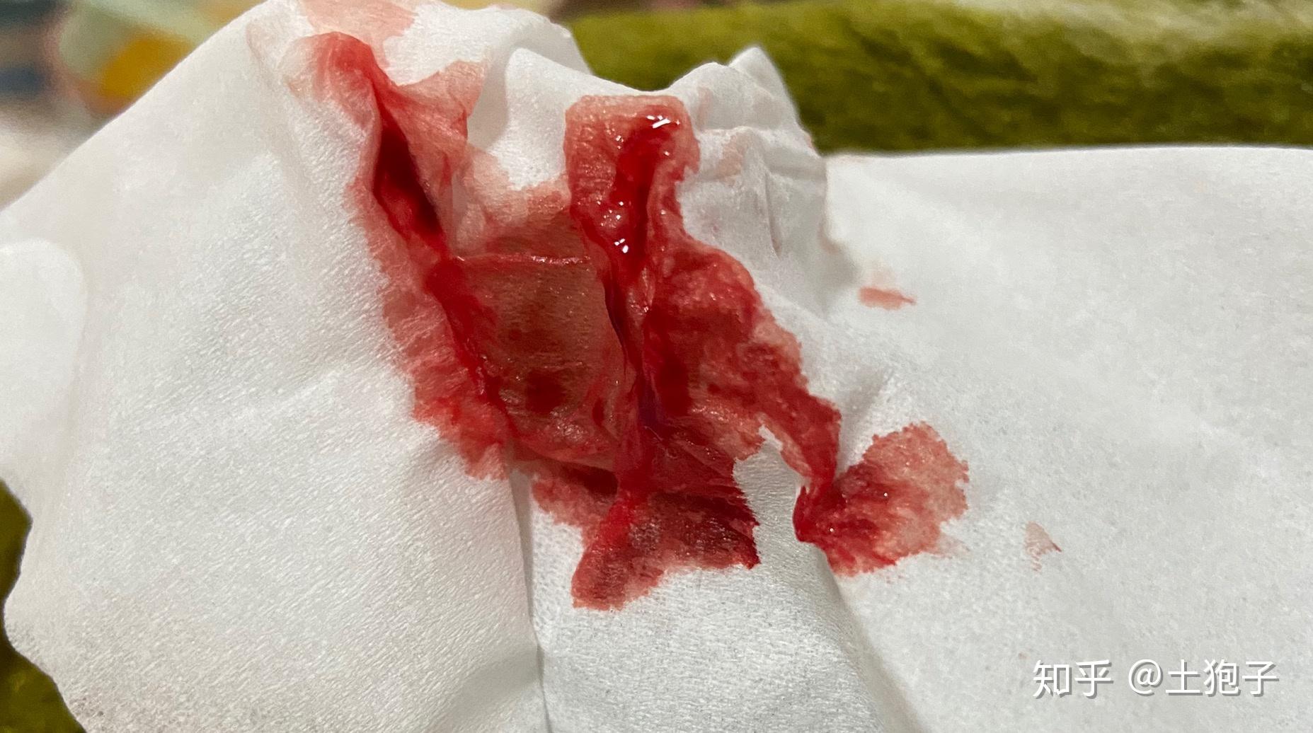 拔智齿后一直流血怎么办? - 知乎