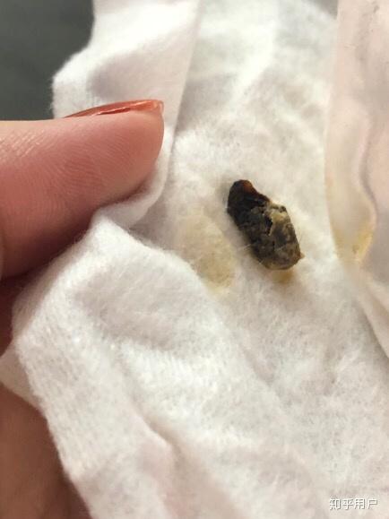 真的有"耳结石"这回事吗? - 知乎