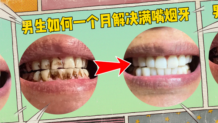 男生抽烟牙黄,牙齿上的黄黑烟渍怎么在1个月内去除?