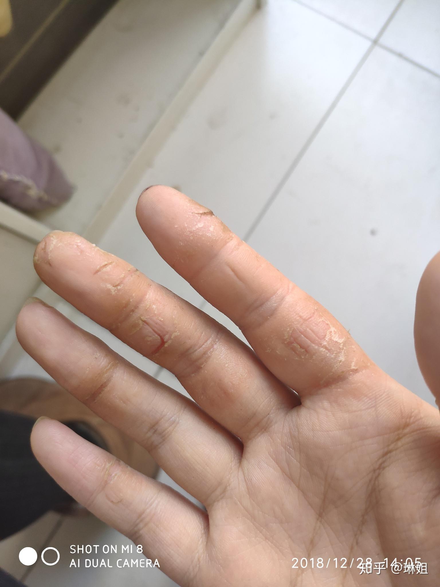 手上干裂型湿疹在哪里看比较好? - 知乎