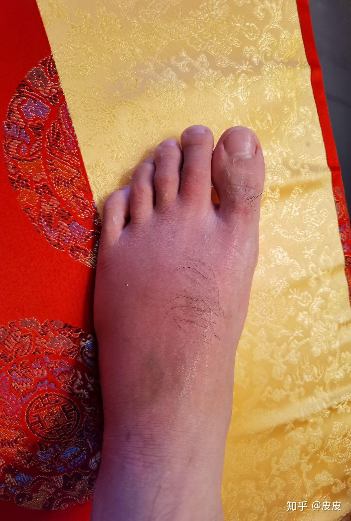 被蚂蚁咬了,伤口周围有硬物感,中间还有个小泡,今天是第三天了还没好