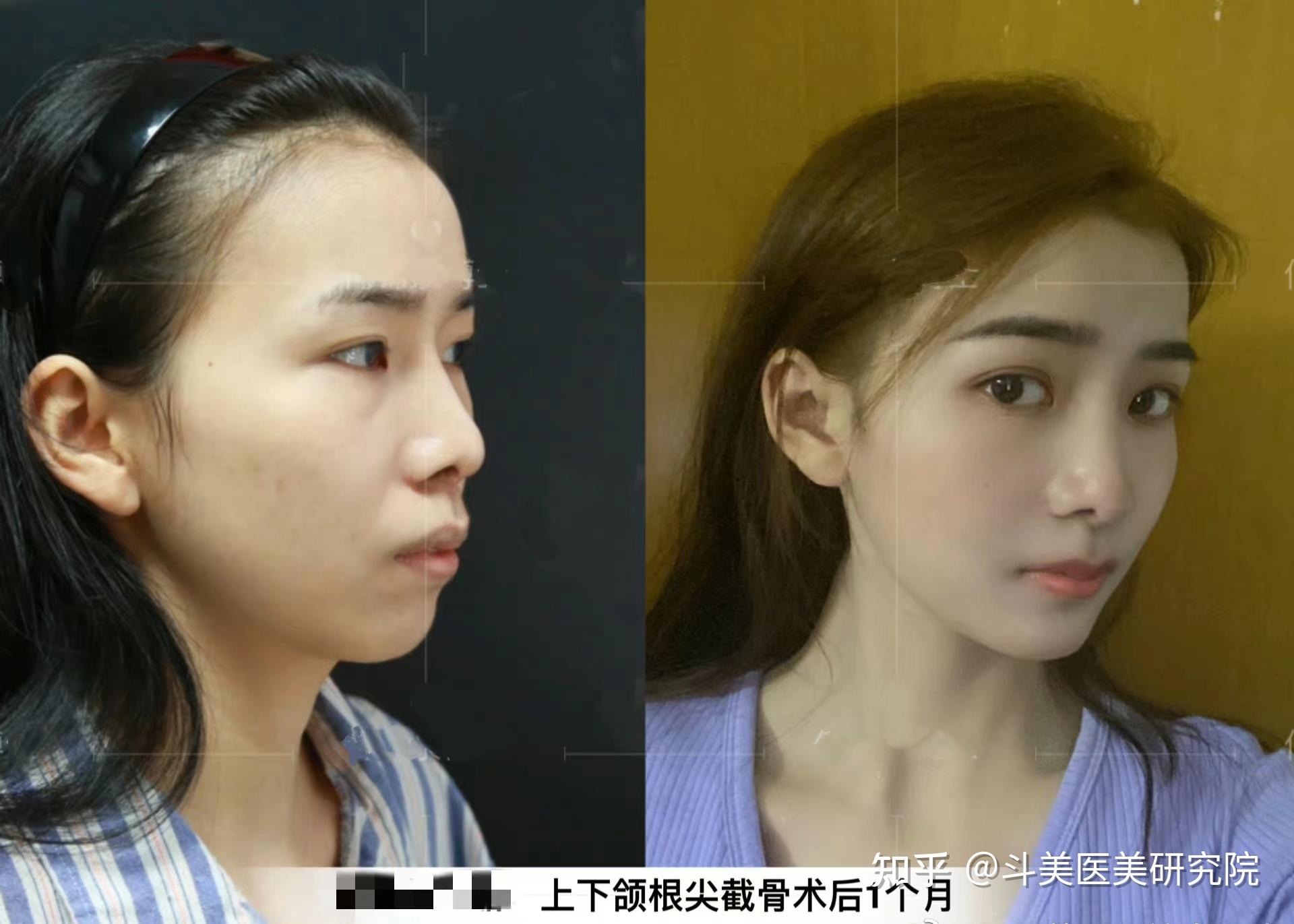 做正颌手术大概要多少钱?国内有哪些做正颌手术比较靠谱的医院医生? - 知乎