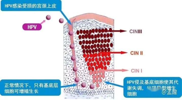 cin3需要子宫全切吗? - 知乎