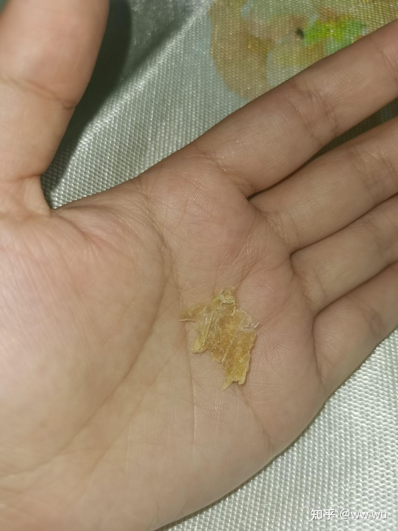 为什么我掏出来的耳屎是桶状的就是一层薄膜粘附在耳壁上