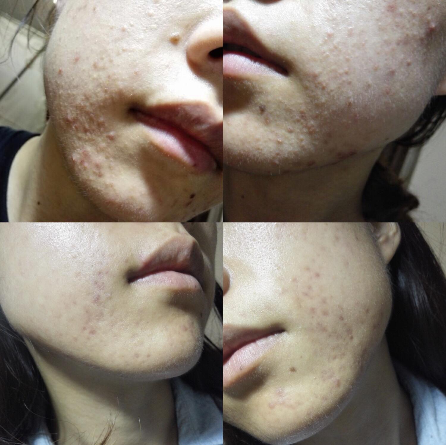 开口闭口型粉刺怎么办? - 知乎