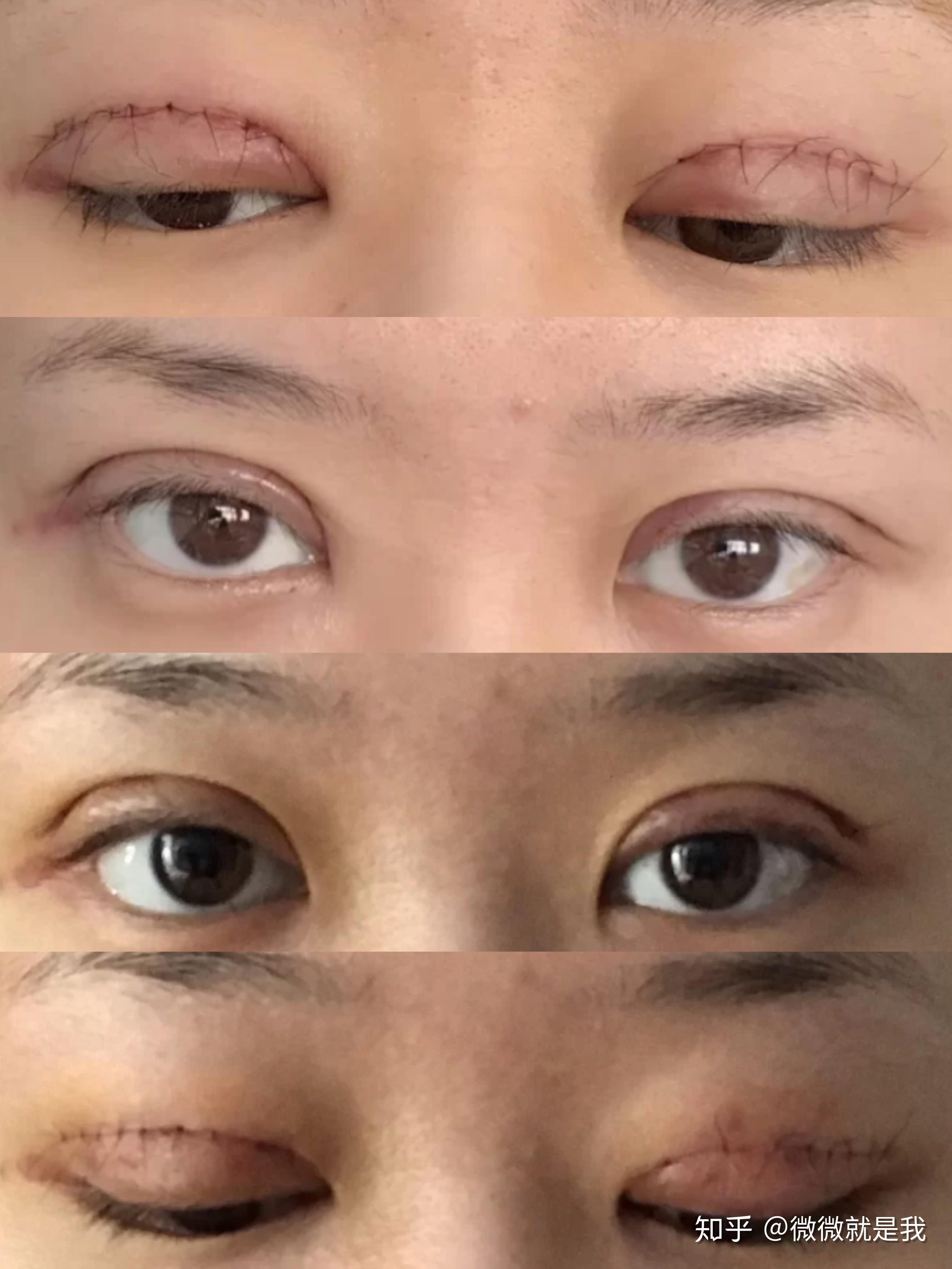 上海双眼皮医院