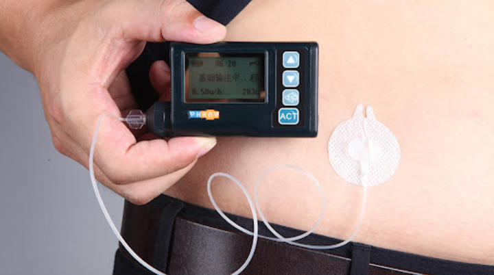 佩戴胰岛素泵治疗,可以降低糖尿病并发症的概率!