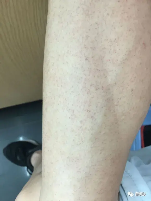 如果瘦下来还会有鸡皮肤吗(胖的人瘦下来鸡皮肤会消失吗)