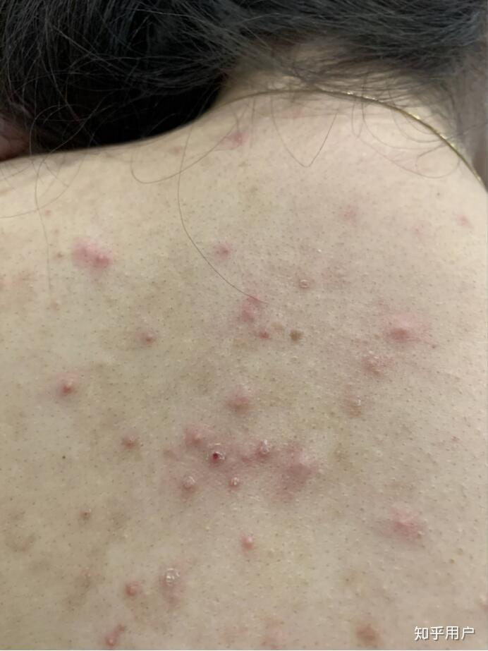 背后胸前长痘怎么办