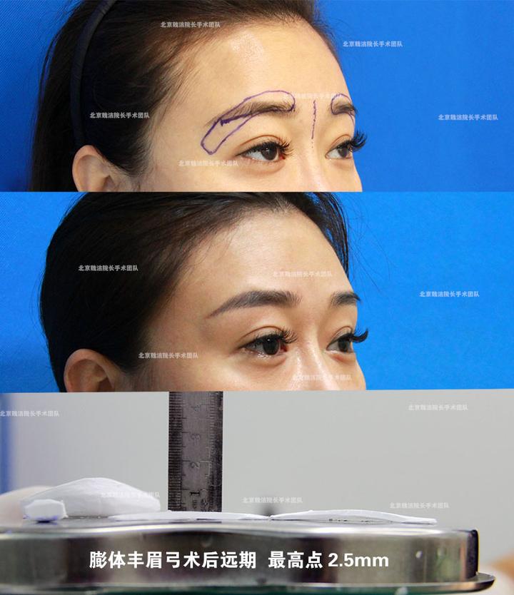 最高点2.5毫米的膨体丰眉弓案例 北京魏洁垫眉弓对比照片 - 知乎