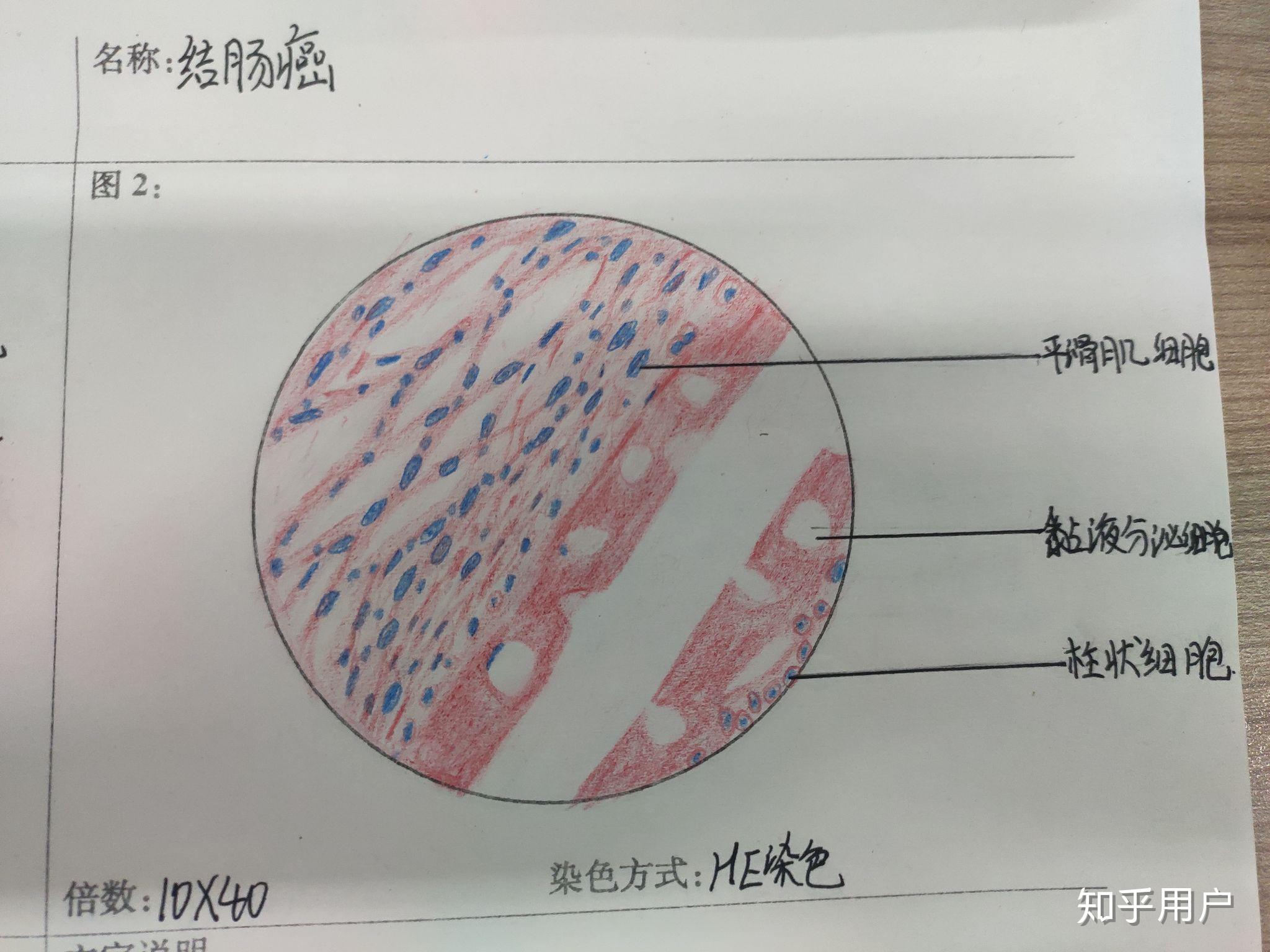 结肠腺癌细胞手绘图图片
