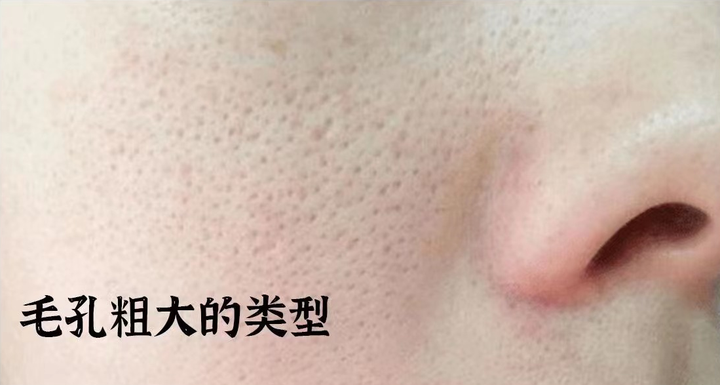 关于毛孔粗大的类型和原因 - 知乎