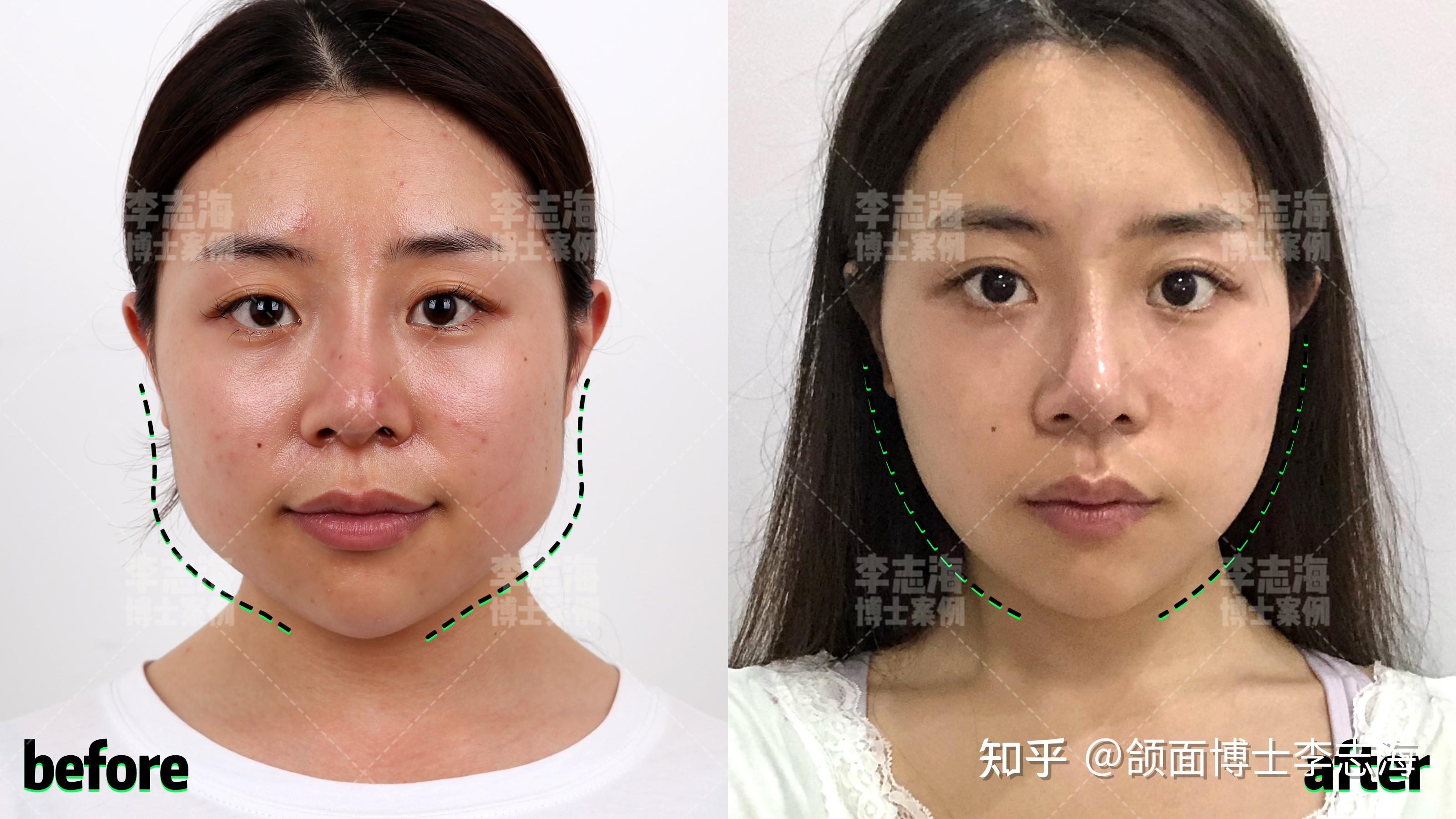 磨骨削骨后对一个人的改变有多大