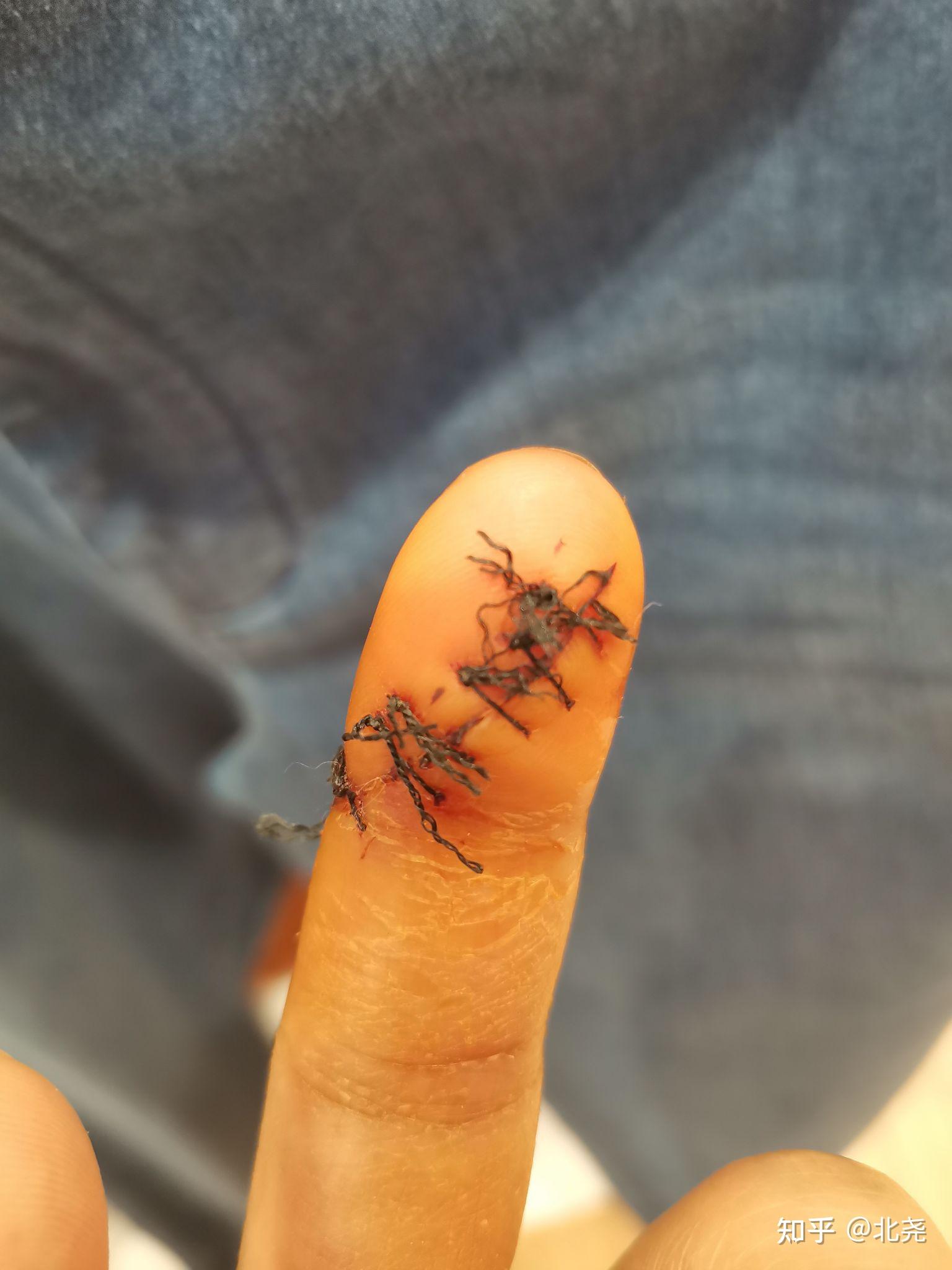 手指肌腱神经断裂需要多久恢复术后9天手指还肿正常吗