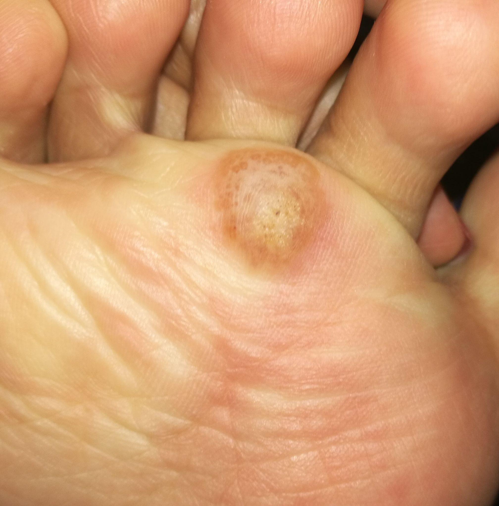 脚上跖疣涂了阿昔洛韦乳膏后涨起来变大感觉里面有液体请问是快好了