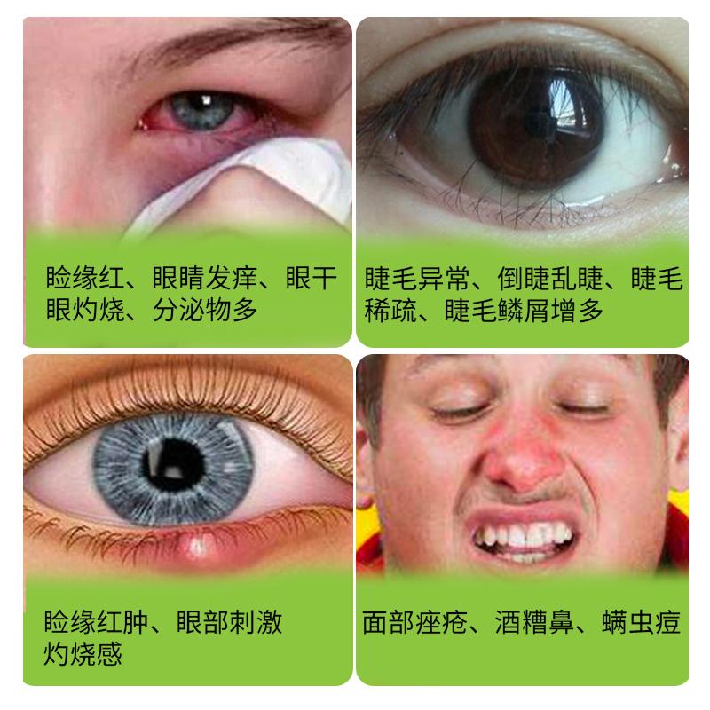 蠕形螨睑缘炎眼睛螨虫干眼的表现 - 知乎