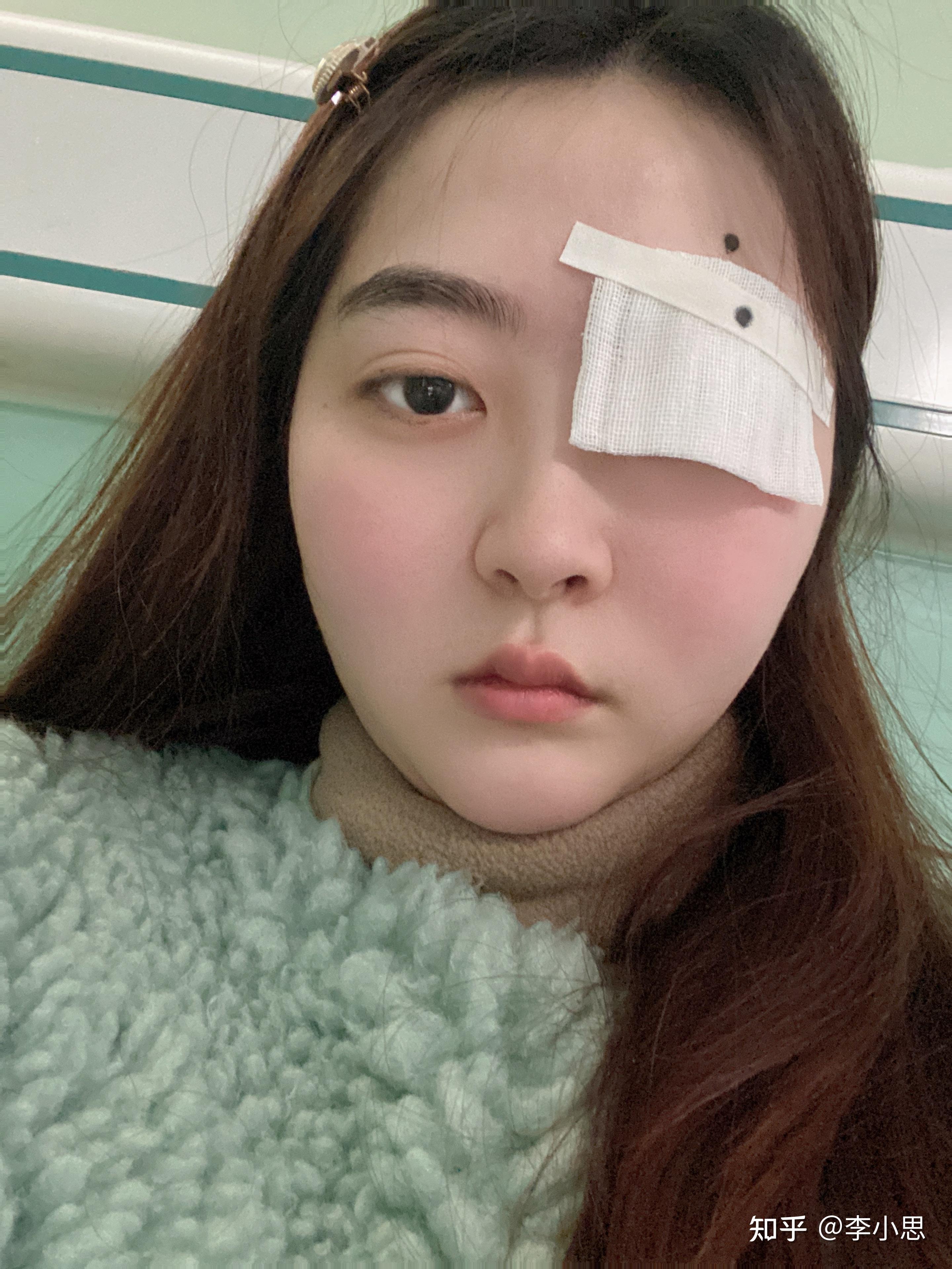 吃糖皮质激素引起的满月脸可以完全恢复吗? - 知乎