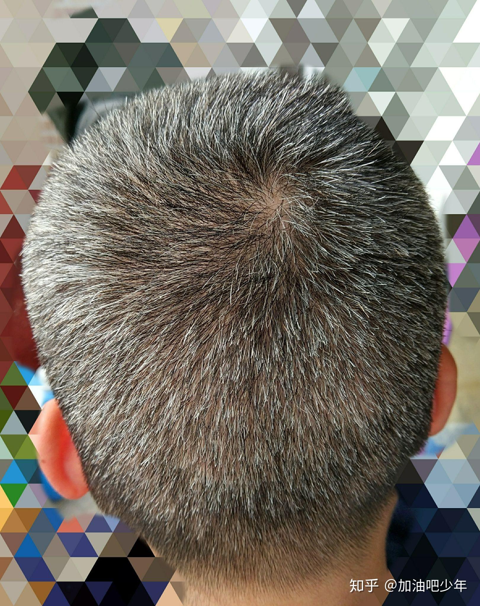 少白头的你现在过的怎么样了?