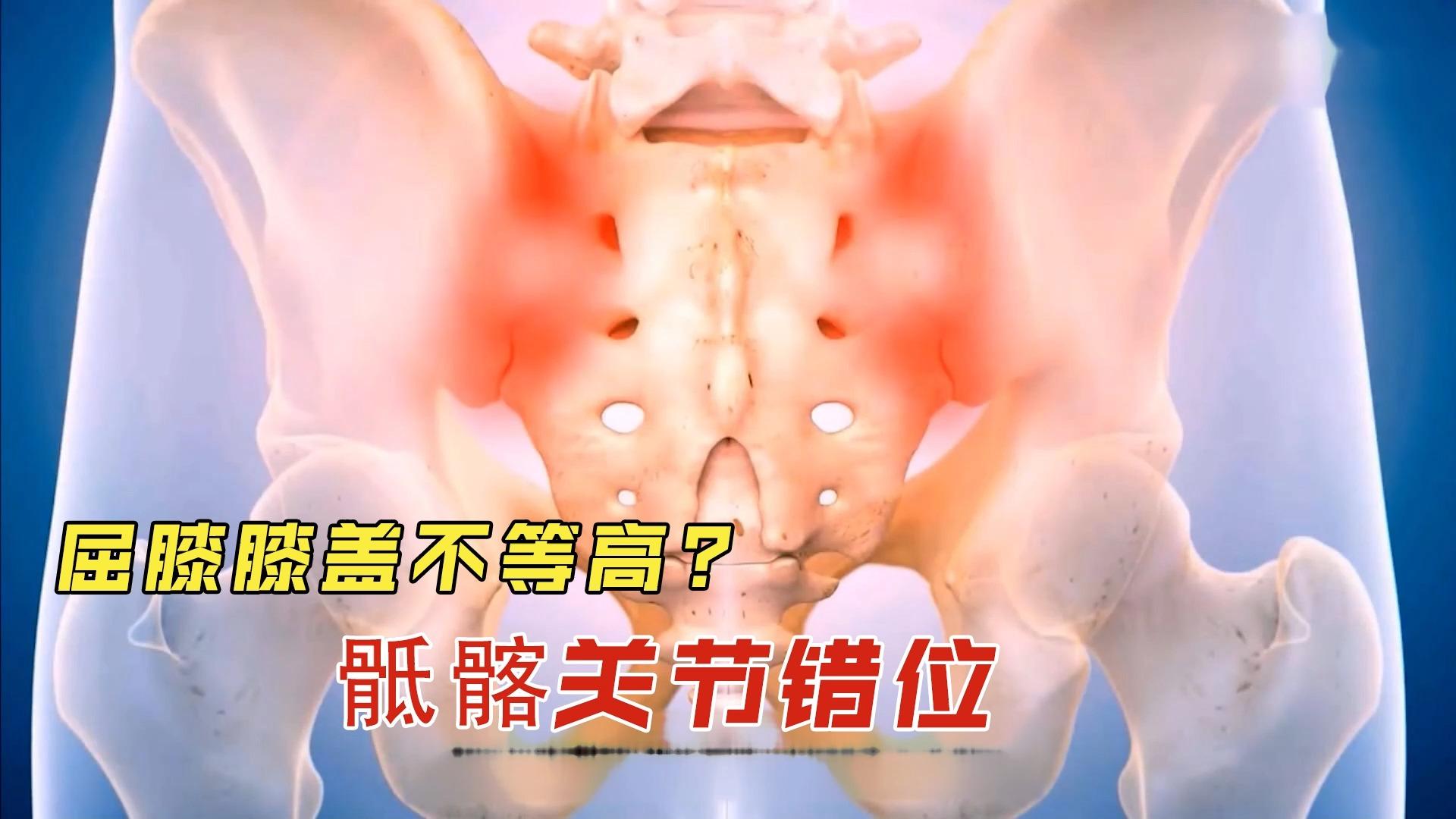 骶髂关节错位有哪些明显的症状?如何自我诊断?