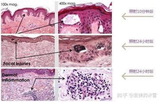 科普四:祛斑怎么选?光子、调Q、皮秒哪个效果好? - 知乎