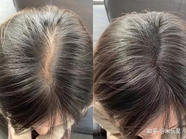熬夜造成的脱发能不能恢复?