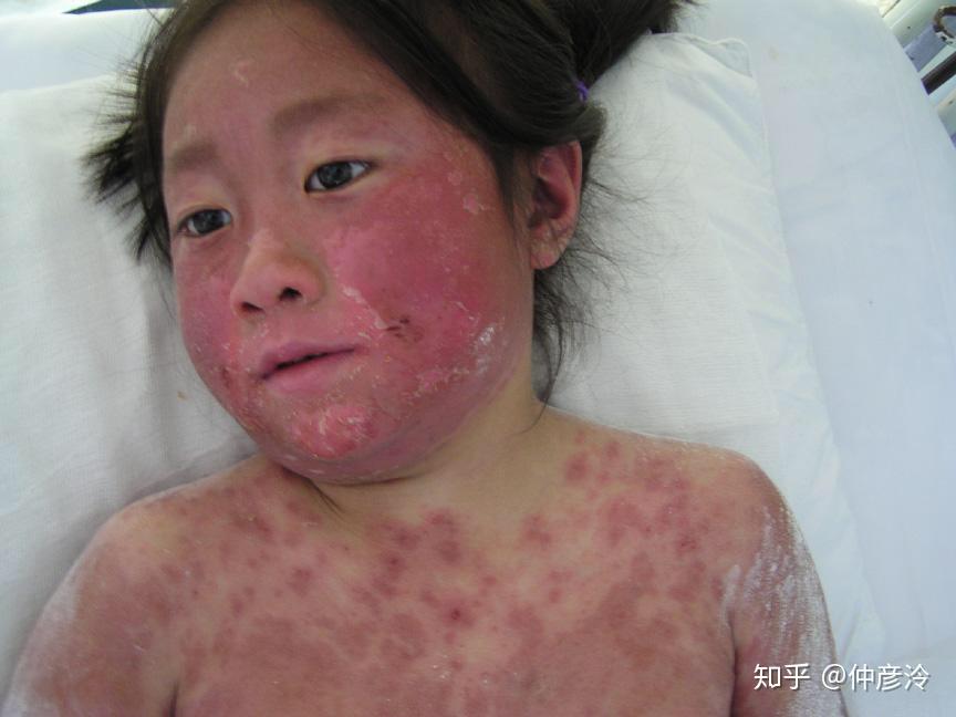 世界上有哪些奇特或者罕见的病症?