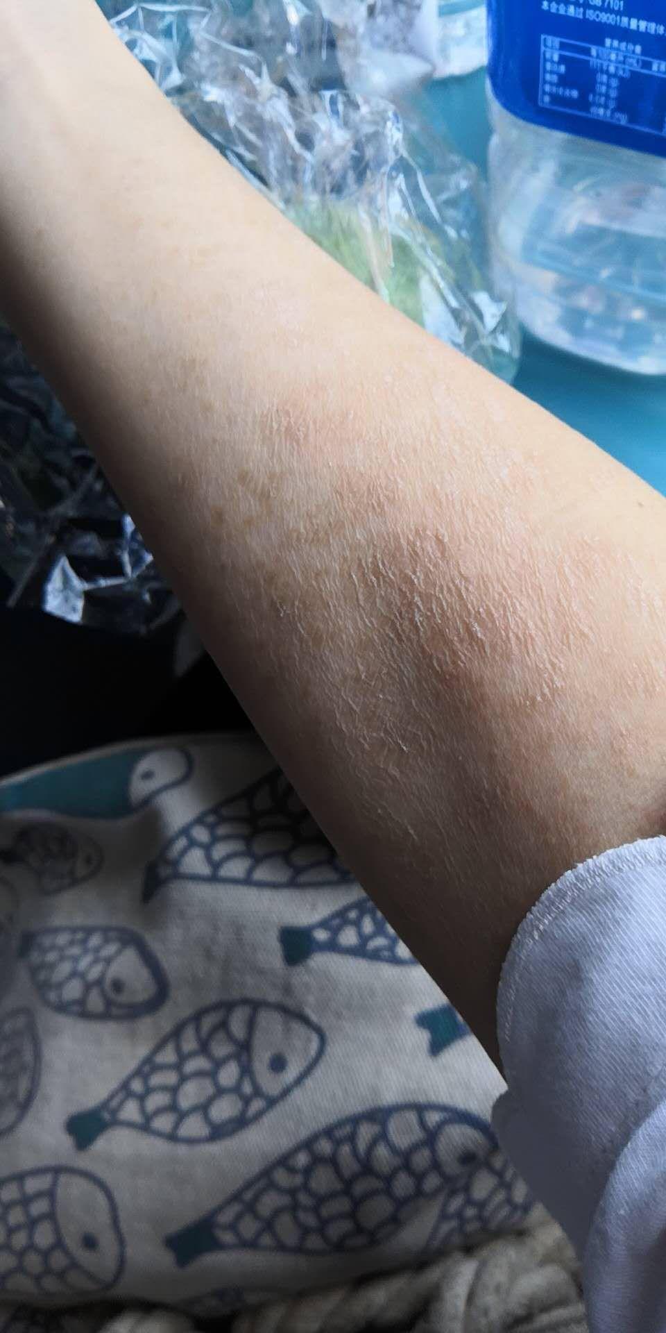 得了玫瑰糠疹怎么办