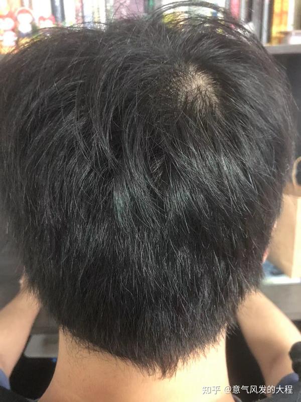 真程植发(真程植发广告)