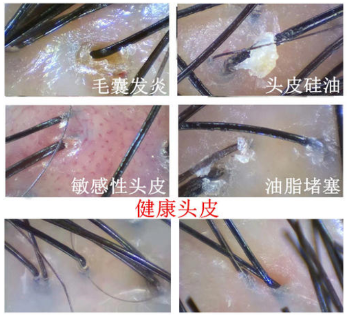 头皮上老是长痘痘,扣了是个血痂要不然就是按着疼的包,这是啥玩意啊? - 知乎