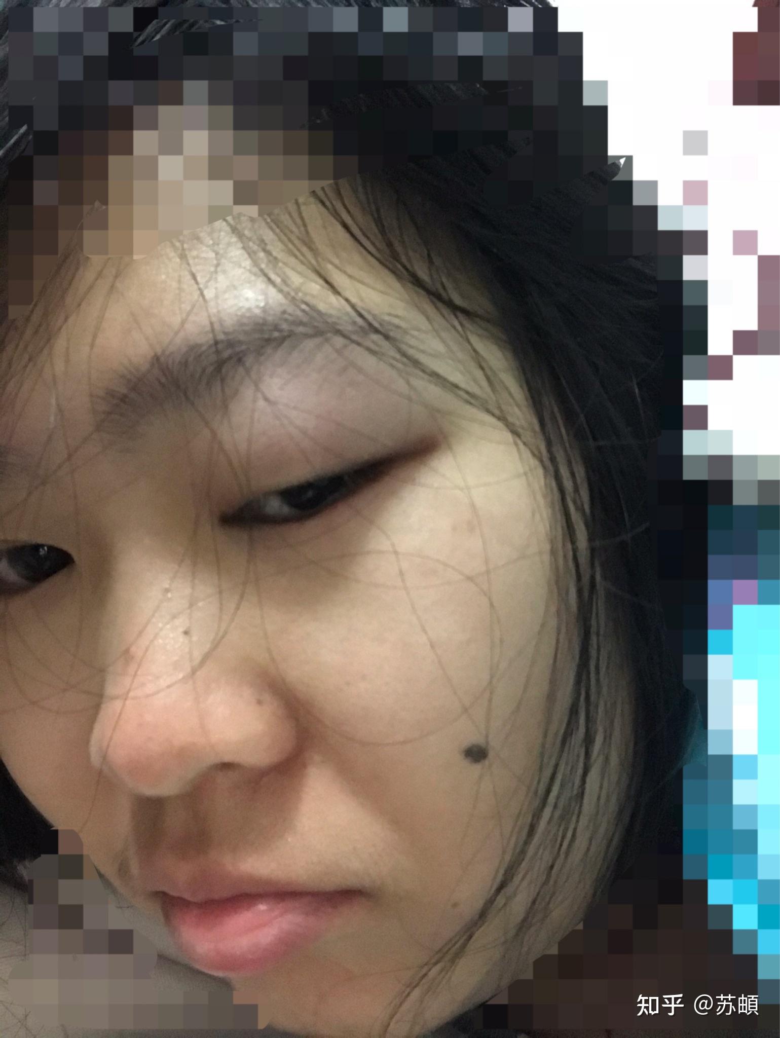 一只眼睛上眼皮和眼角突然肿了 这是为什么?