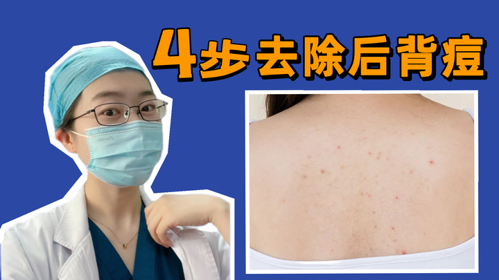 【背部长痘】后背反复长痘,春夏都不敢漏背......皮肤科医生告诉你,只有做好这4步,才能解决后背长痘的烦恼! - 知乎