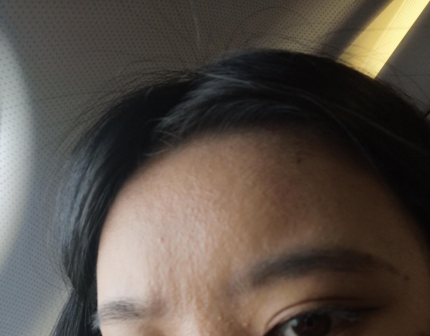 额头长了好多小疙瘩这是粉刺还是痘痘还是脂溢性皮炎