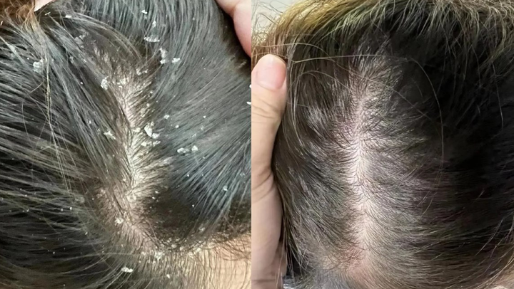 男生头皮屑大块大块地掉,出油发痒忍不住挠,指甲缝里全是白泥!咋办?皮肤科医生教你3步杀招!一个月解决去屑烦恼 - 知乎