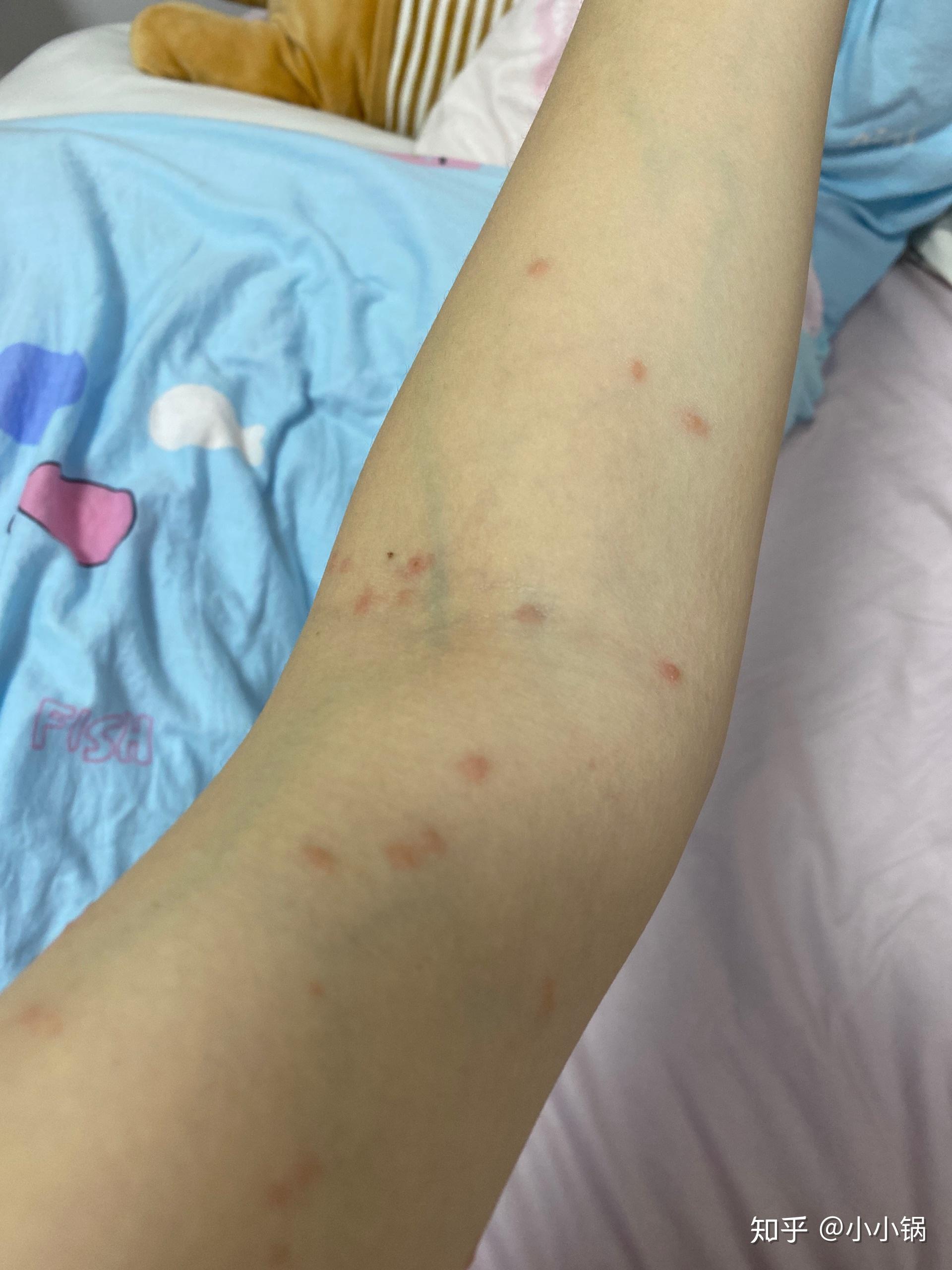 养猫之后身上起小红点是什么?怎么办? - 知乎