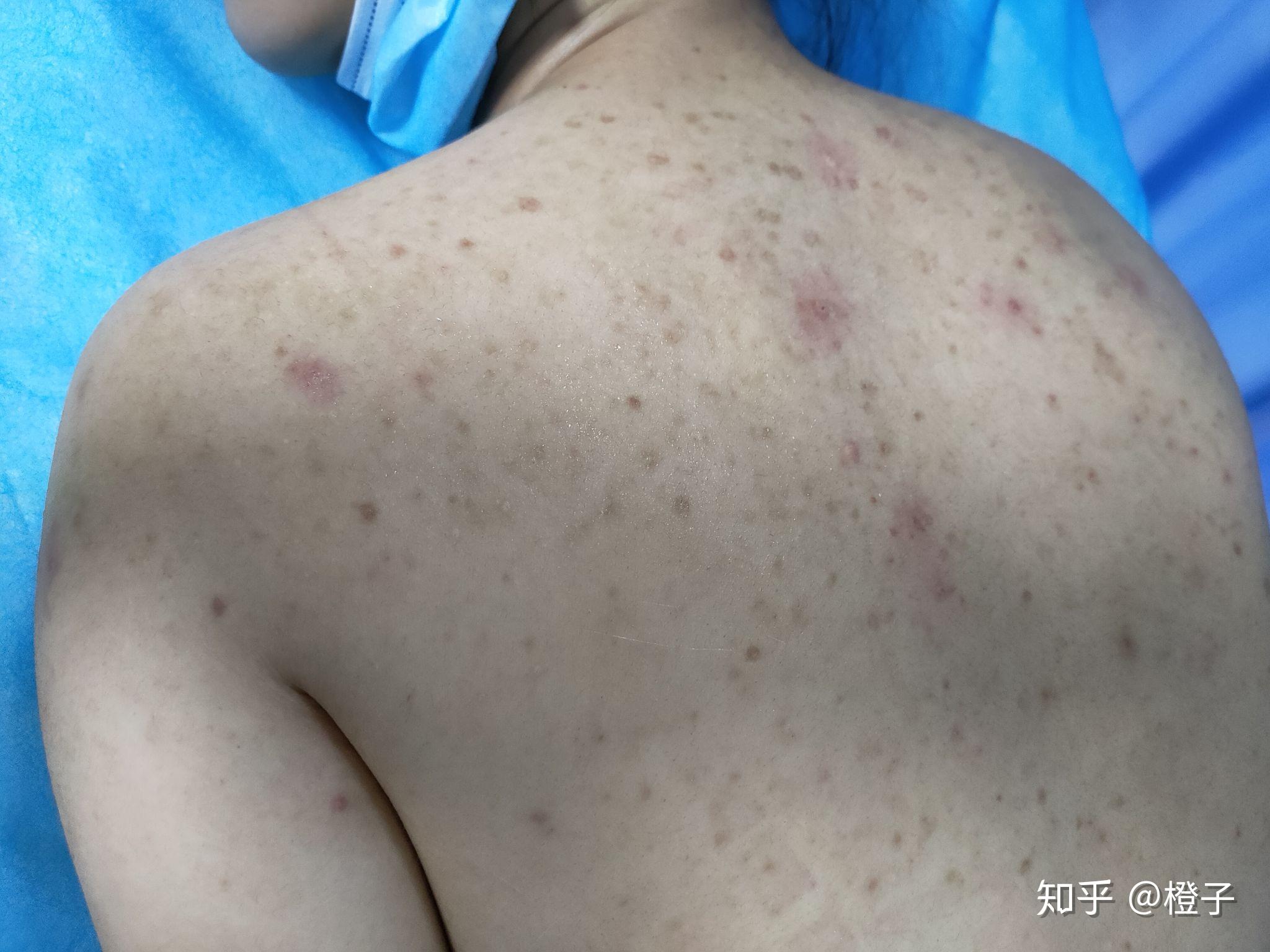 如何去背部痘痘及痘印 - 知乎