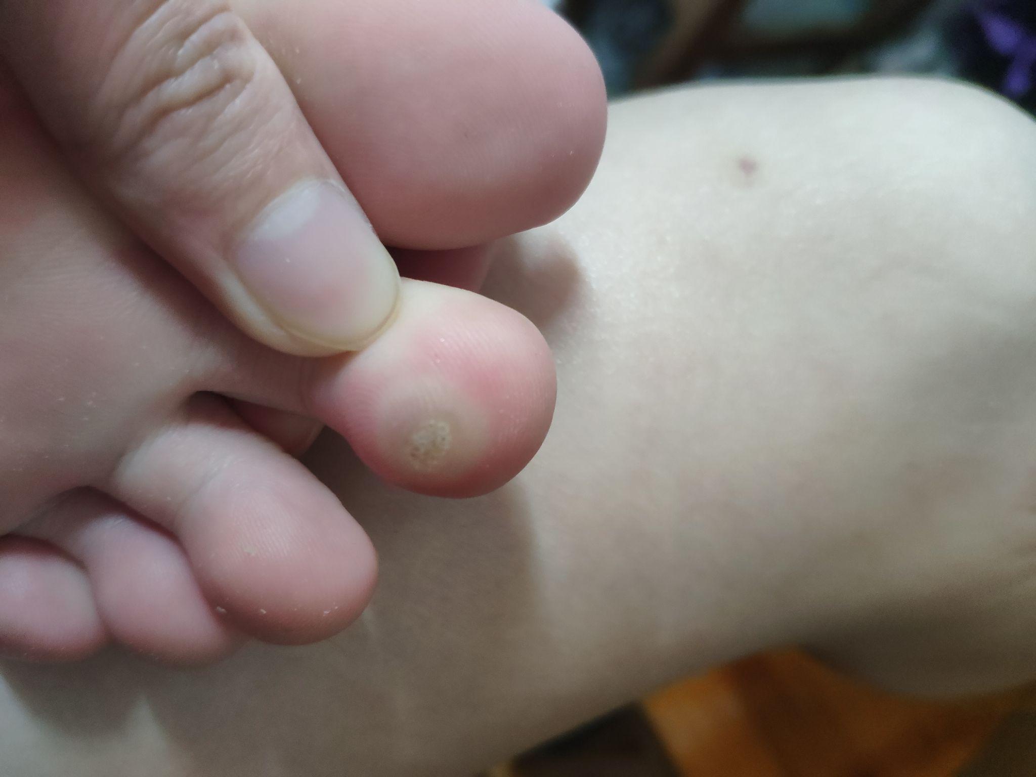 甲下寻常疣做液氮冷冻疼哭了,可耐受疼痛真的这么厉害吗?