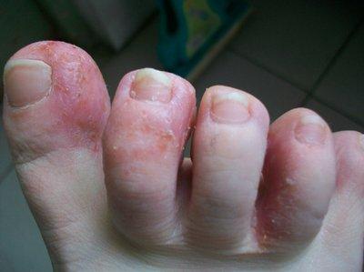 被传染脚气了,脚趾间涨了好多小水泡,有什么好的方法吗?