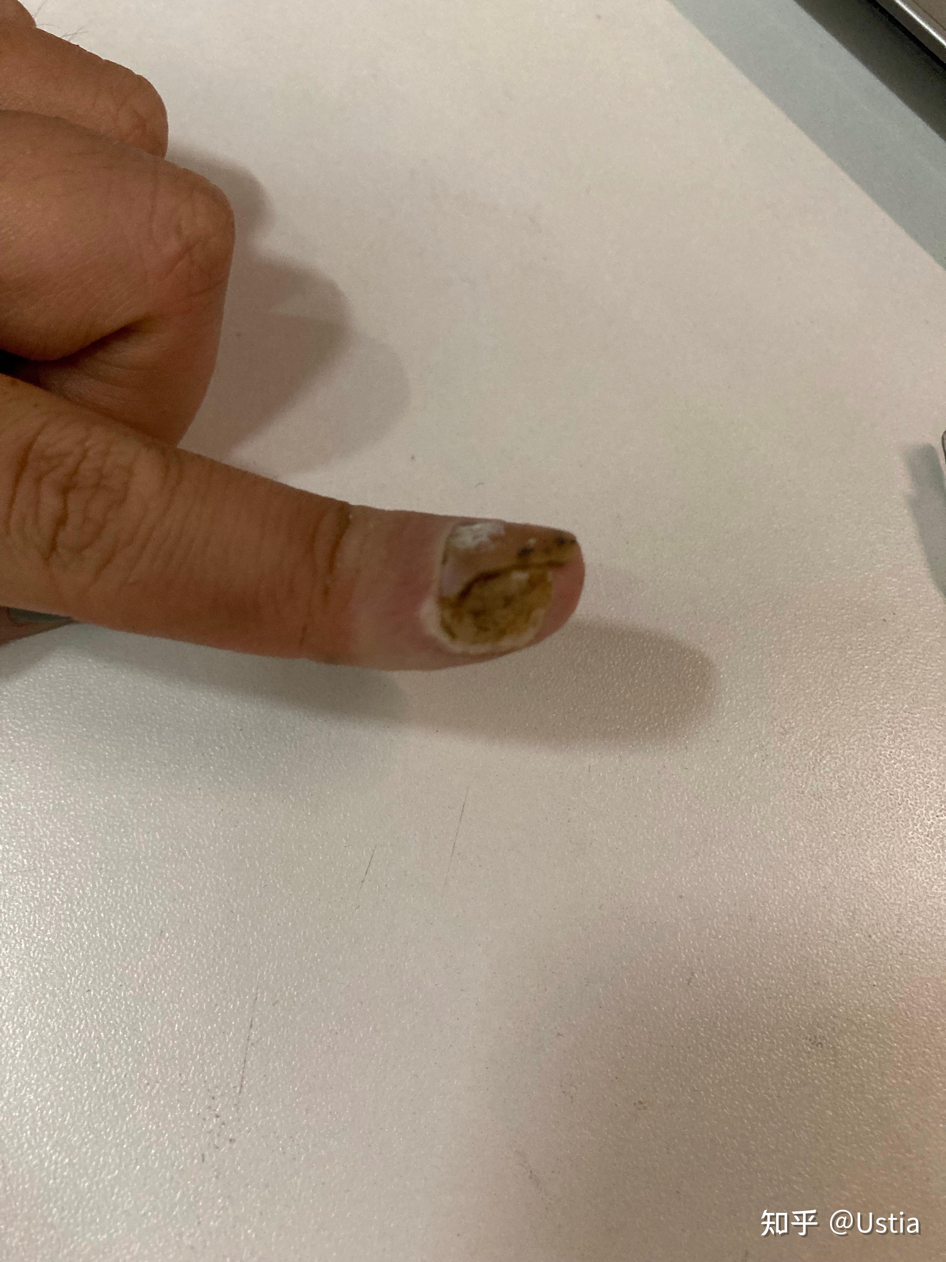 各位大神鄙人手残手指甲旁边长了死皮用指甲刀剪的时候把一些肉也剪了