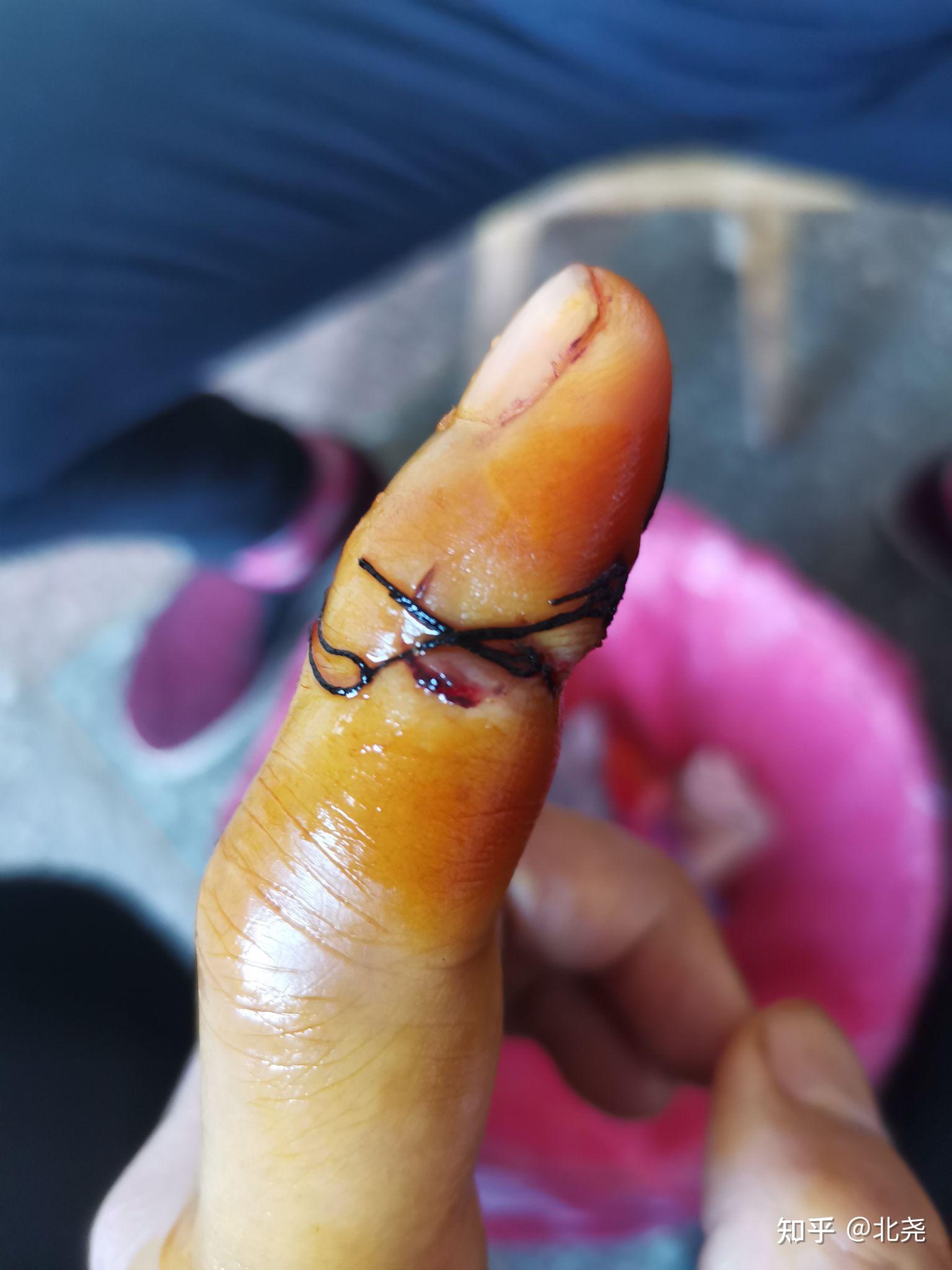 手指肌腱神经断裂需要多久恢复术后9天手指还肿正常吗