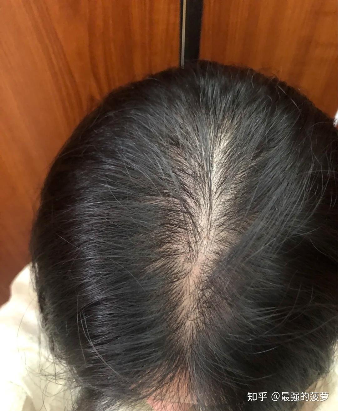 女生 发量少 头顶快秃了 有没有什么好的生发方法!跪求! - 知乎