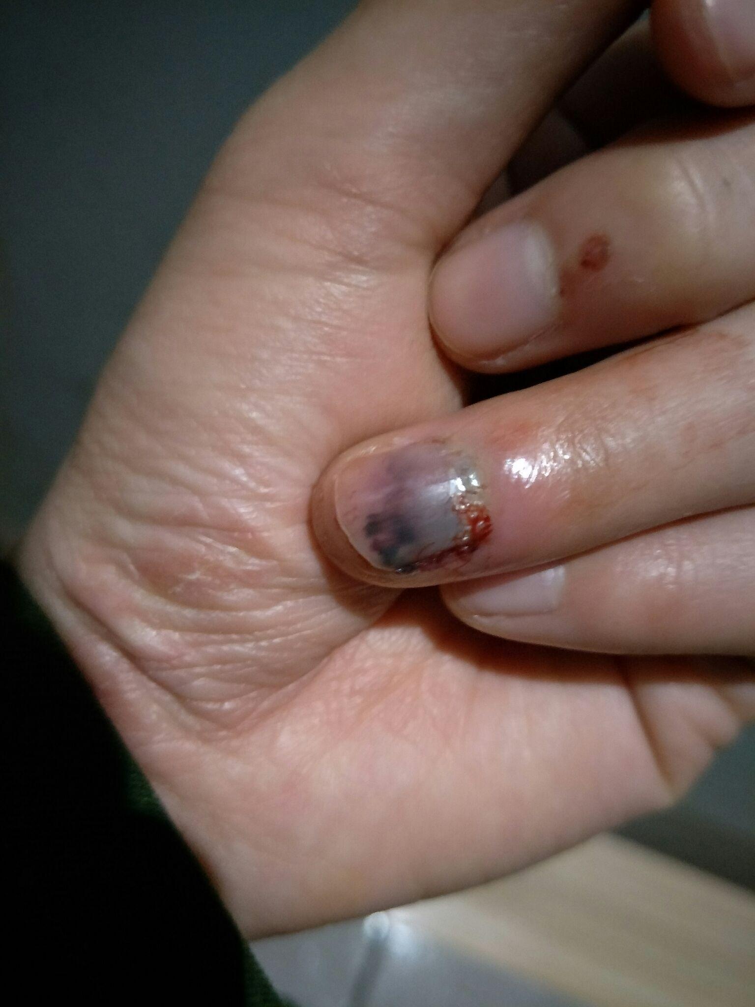 手指被门夹到飙泪是种怎样的体验? - 知乎