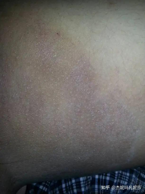 大腿内侧发黑瘙痒 知乎