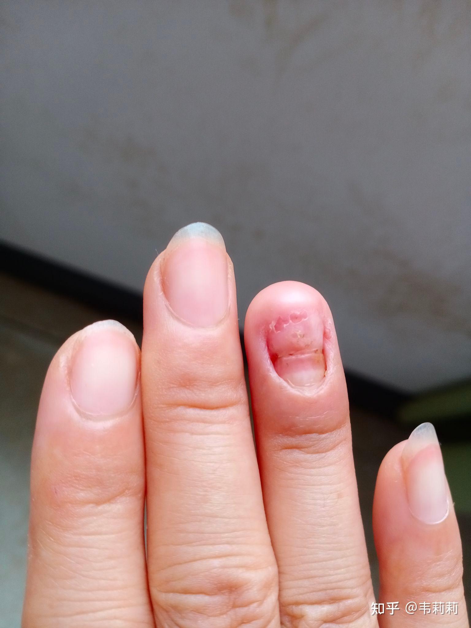 手指甲不小心被砸到发黑发肿该怎么处理