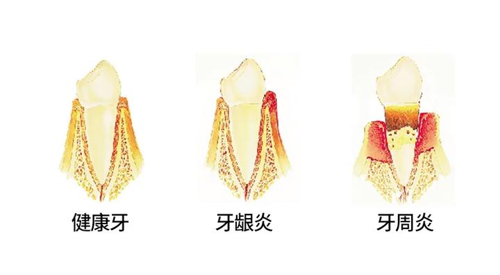 牙龈炎、牙周炎怎么分辨? - 知乎