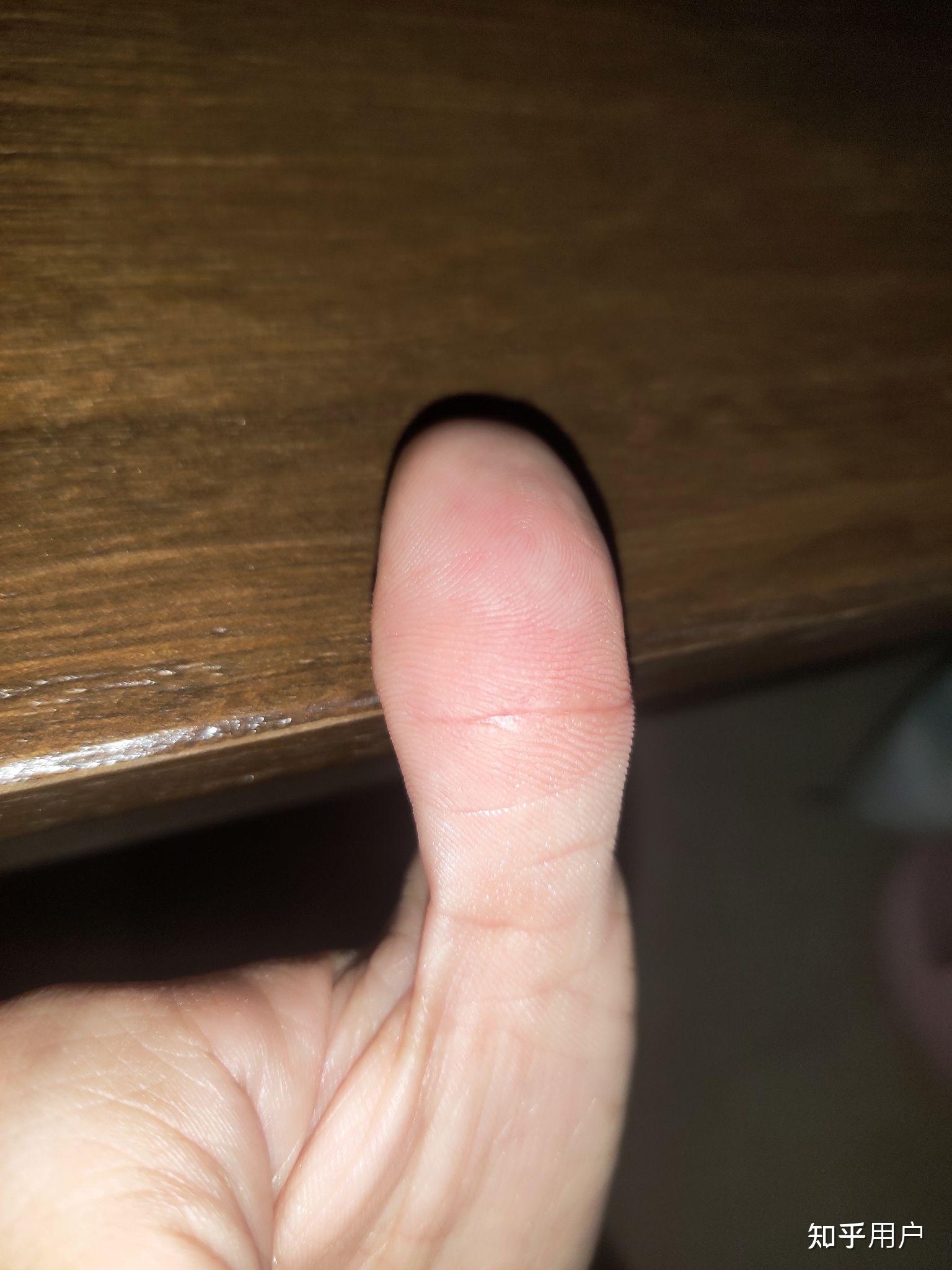 大拇指内侧皮肤发硬,喜欢撕下角质层,十年了……怎么能恢复正常皮肤哦