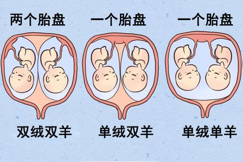 异卵双胞胎